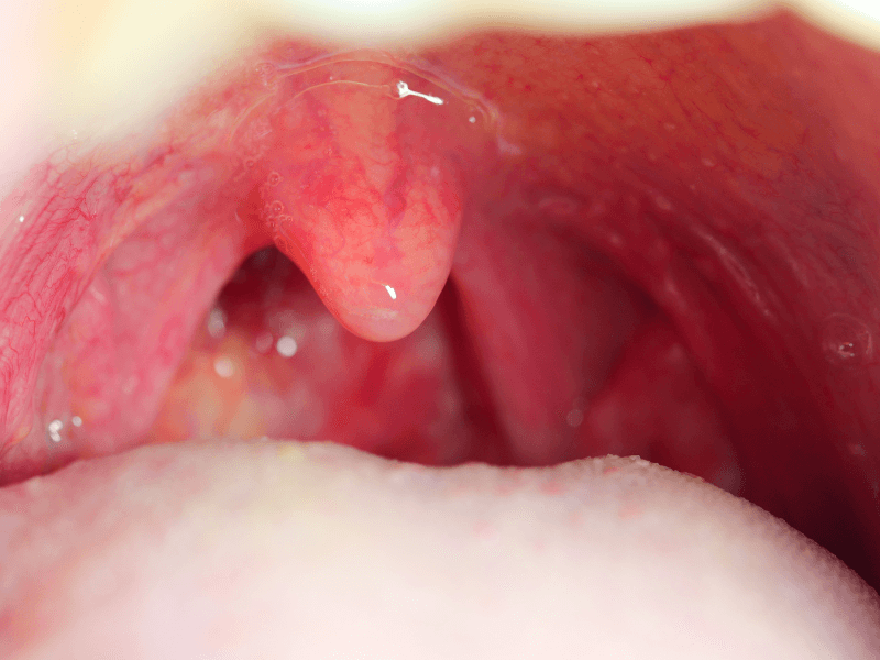 Đau họng mà không sốt có phải là triệu chứng của COVID-19 không? - Microlife