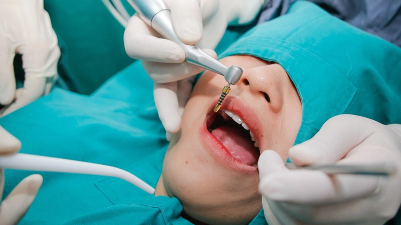 Bao lâu sau khi nhổ răng thì có thể cấy ghép implant?