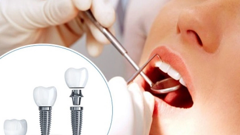 Bao lâu sau khi nhổ răng thì có thể cấy ghép implant?