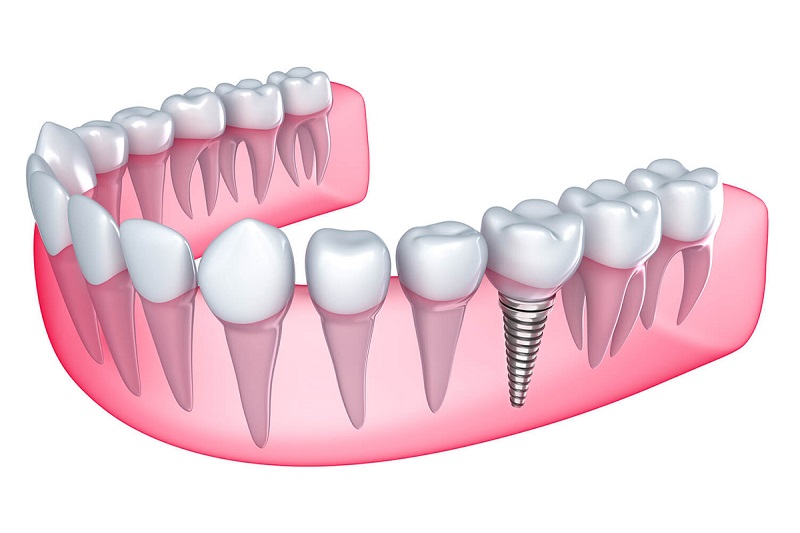 Trồng răng implant - Nha khoa Marina